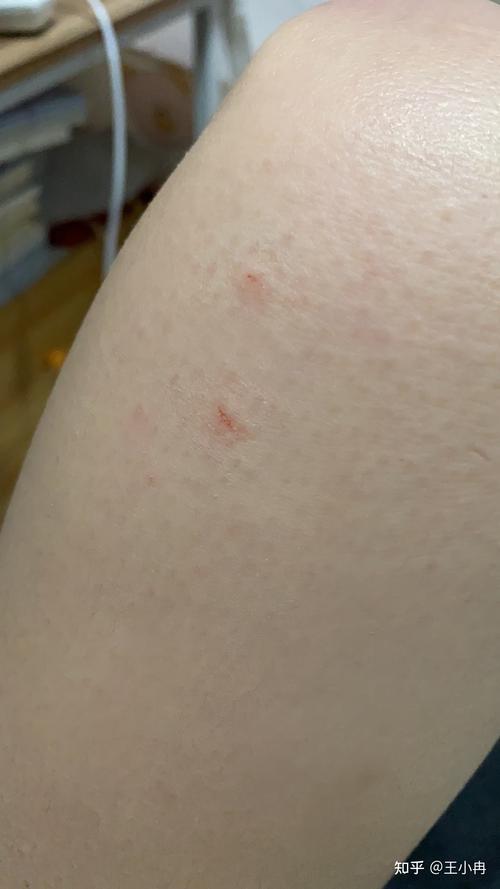 猫猫抓了要不要打疫苗,猫咪抓了需要打针吗-第6张图片-后鲨宠物 猫猫抓了要不要打疫苗,猫咪抓了需要打针吗-第6张图片-后鲨宠物