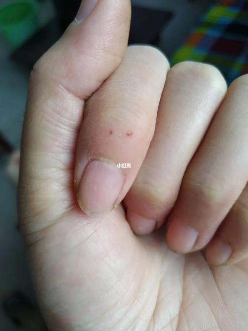 被自己的猫咪咬出血了,被自己的猫咬伤了?-第5张图片-后鲨宠物 被自己的猫咪咬出血了,被自己的猫咬伤了?-第5张图片-后鲨宠物