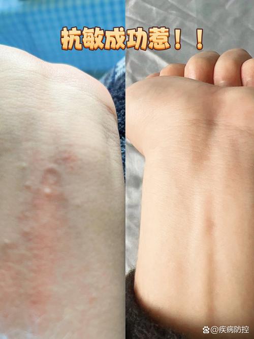 对猫咪过敏怎么办_对猫咪过敏怎么办?又想养猫-第2张图片-后鲨宠物