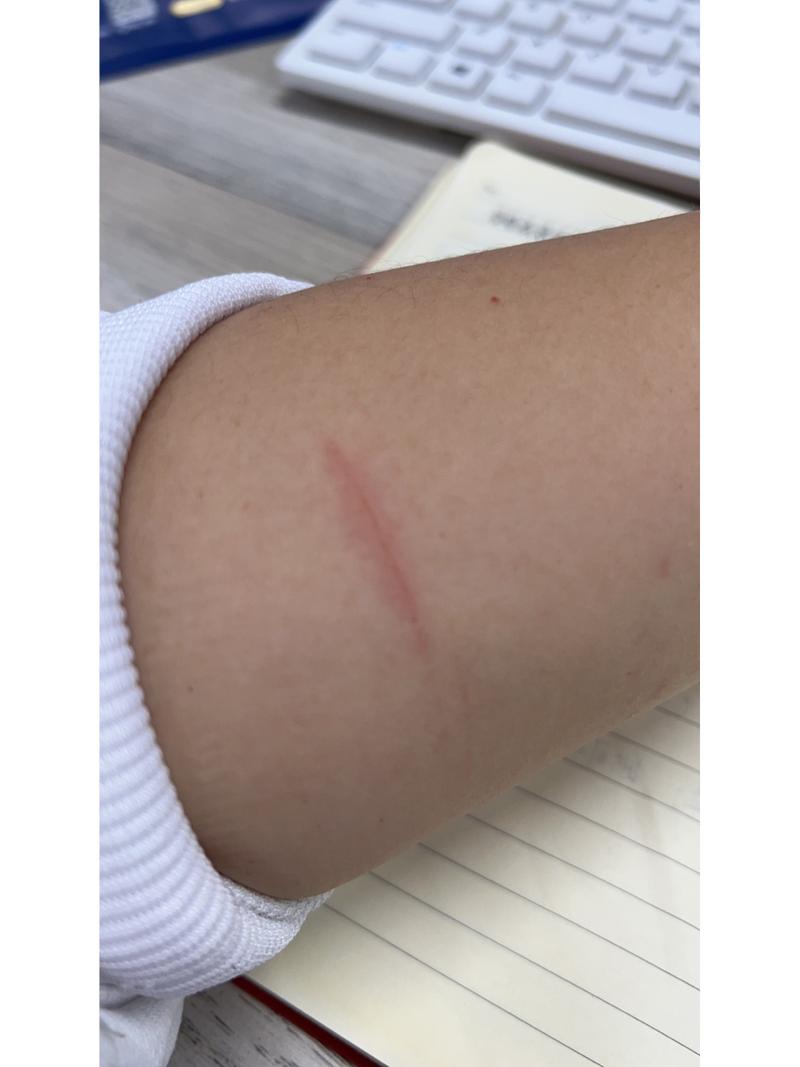 被自家狗狗抓伤要不要打针,被自家狗狗抓了一下!!!!求助!-第2张图片-后鲨宠物 被自家狗狗抓伤要不要打针,被自家狗狗抓了一下!!!!求助!-第2张图片-后鲨宠物