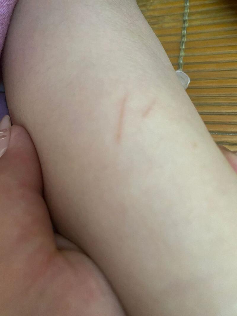 被猫咪抓伤了要打针吗,被猫咪抓了用不用打针疫苗-第6张图片-后鲨宠物 被猫咪抓伤了要打针吗,被猫咪抓了用不用打针疫苗-第6张图片-后鲨宠物