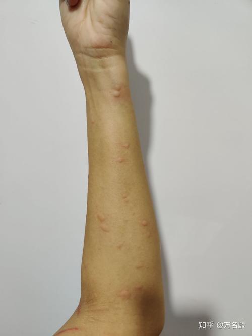  人对狗狗过敏有哪些症状，人对狗狗过敏有哪些症状图片-第5张图片-后鲨宠物