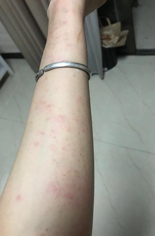  人对狗狗过敏有哪些症状，人对狗狗过敏有哪些症状图片-第4张图片-后鲨宠物