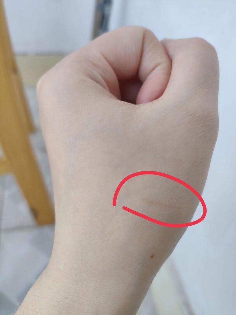  被猫咪咬了没出血，被猫咪咬了没出血要打针吗-第5张图片-后鲨宠物