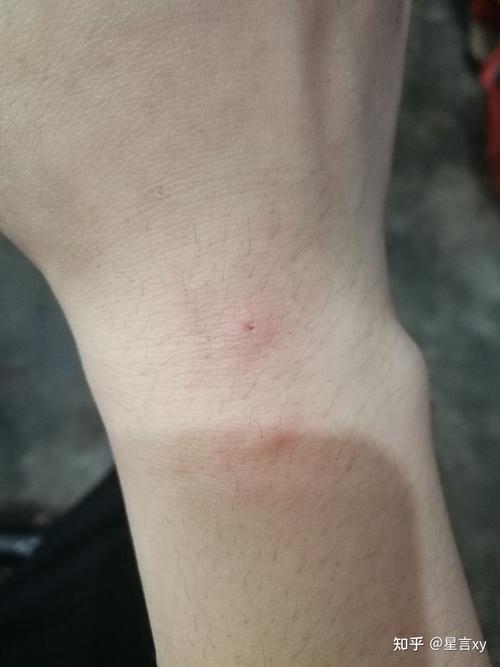 被自己家猫咪咬出血了,被自己家猫咪咬出血了怎么办?-第1张图片-后鲨宠物 被自己家猫咪咬出血了,被自己家猫咪咬出血了怎么办?-第1张图片-后鲨宠物