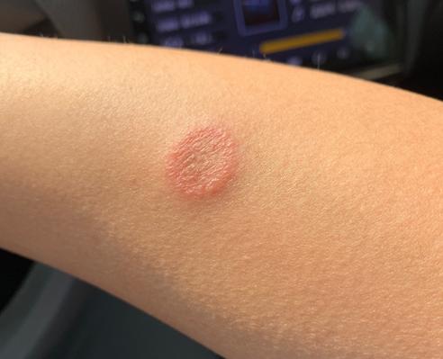 猫咪猫藓可以自愈吗,猫咪猫藓会自己痊愈吗-第3张图片-后鲨宠物 猫咪猫藓可以自愈吗,猫咪猫藓会自己痊愈吗-第3张图片-后鲨宠物