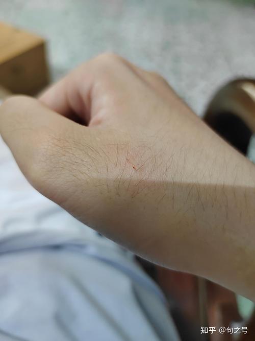 猫咪挠出血了怎么办,猫咪挠出血需要打疫苗吗-第5张图片-后鲨宠物 猫咪挠出血了怎么办,猫咪挠出血需要打疫苗吗-第5张图片-后鲨宠物