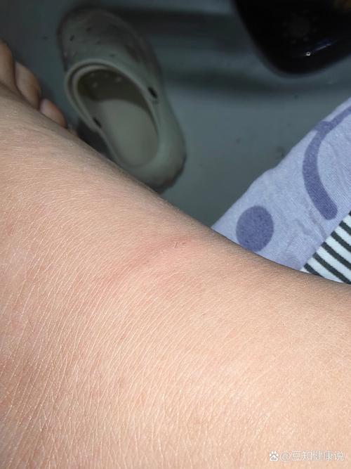 被狗狗抓伤怎么办_狗狗抓伤怎么办用什么药-第1张图片-后鲨宠物 被狗狗抓伤怎么办_狗狗抓伤怎么办用什么药-第1张图片-后鲨宠物