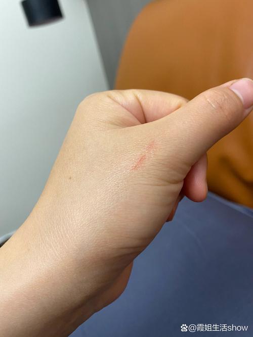 被猫咪抓破皮要打针吗,被猫咪抓了破皮了有没有什么事-第2张图片-后鲨宠物 被猫咪抓破皮要打针吗,被猫咪抓了破皮了有没有什么事-第2张图片-后鲨宠物