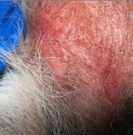 狗狗红疹怎么治疗方法,狗狗起红疹带白色皮屑-第4张图片-后鲨宠物 狗狗红疹怎么治疗方法,狗狗起红疹带白色皮屑-第4张图片-后鲨宠物