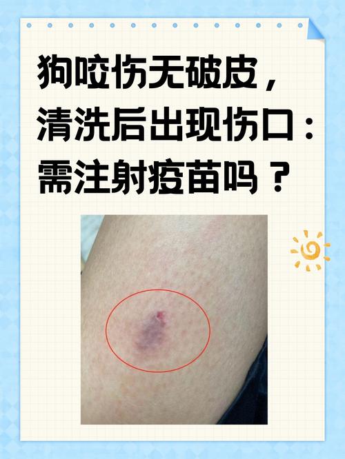 家养狗狗咬了要打针吗_被家养狗狗咬伤需要打疫苗针吗-第2张图片-后鲨宠物