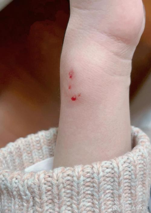 家养狗狗咬了要打针吗_被家养狗狗咬伤需要打疫苗针吗-第6张图片-后鲨宠物