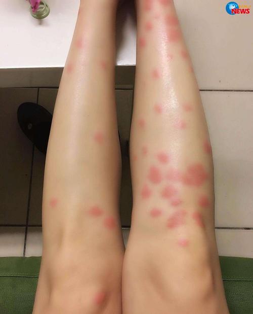 狗狗被跳蚤咬了怎么办,狗狗被跳蚤咬了怎么办图片?-第2张图片-后鲨宠物 狗狗被跳蚤咬了怎么办,狗狗被跳蚤咬了怎么办图片?-第2张图片-后鲨宠物