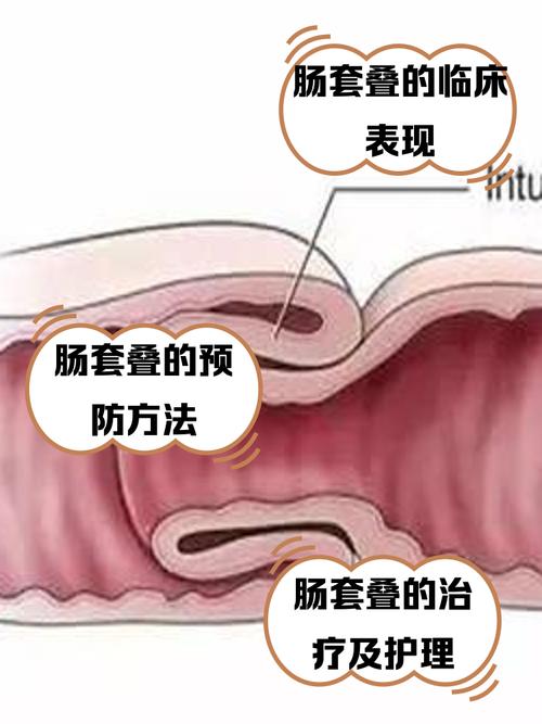 狗狗肠套叠可以自愈吗_狗狗肠套叠可以自愈吗视频-第3张图片-后鲨宠物 狗狗肠套叠可以自愈吗_狗狗肠套叠可以自愈吗视频-第3张图片-后鲨宠物