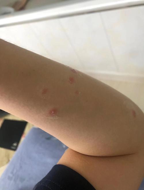  狗狗得了皮肤病会传染人吗，狗狗得了皮肤病会传染给别的狗狗吗