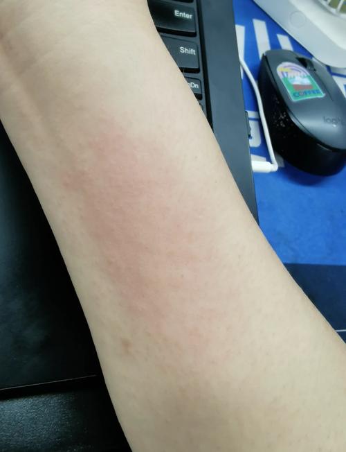 猫咪打疫苗过敏,猫咪打疫苗过敏了自行能好吗-第3张图片-后鲨宠物 猫咪打疫苗过敏,猫咪打疫苗过敏了自行能好吗-第3张图片-后鲨宠物