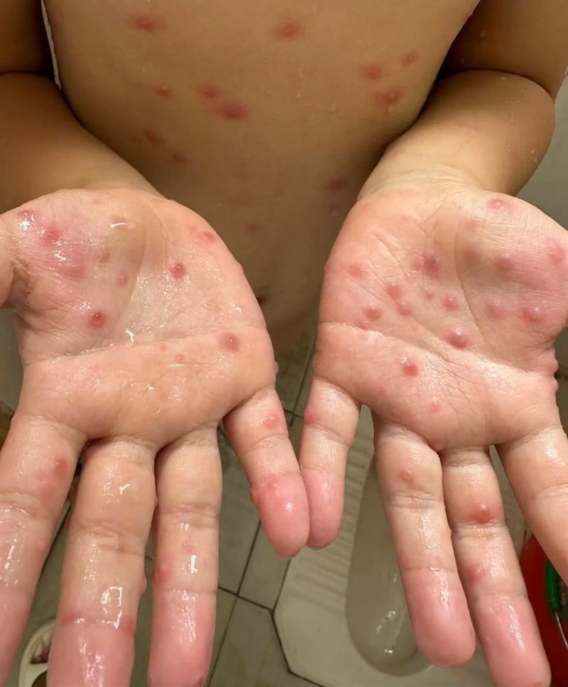 水痘会传染给狗狗吗,水痘会不会传染给宠物-第4张图片-后鲨宠物 水痘会传染给狗狗吗,水痘会不会传染给宠物-第4张图片-后鲨宠物