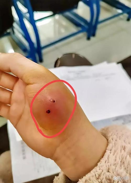 猫咪咬了蝙蝠怎么办，猫咬了蝙蝠有没有事儿?？-第2张图片-后鲨宠物