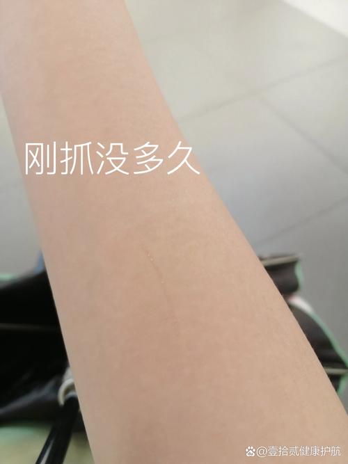 被猫咪抓了没出血,被猫咪抓了没出血会有事吗?-第1张图片-后鲨宠物 被猫咪抓了没出血,被猫咪抓了没出血会有事吗?-第1张图片-后鲨宠物